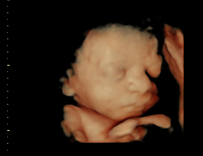 3D ultrasound image at 31 weeks